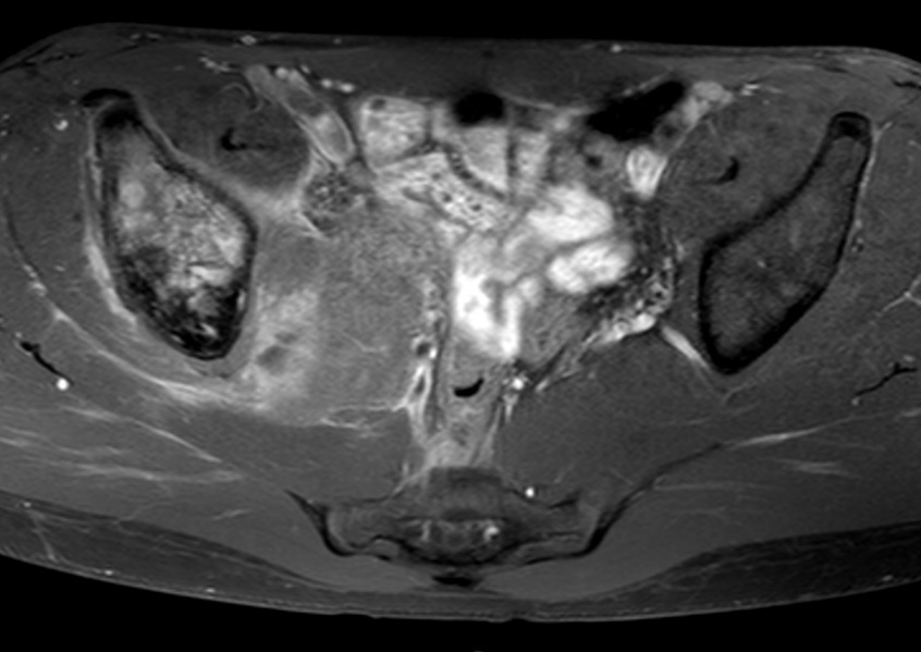 Figure 6 for case Ewing sarcoma ( RID4522 )